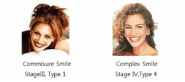 좌측의 미소는 윗니만 보이는 미소이며, 자연스러운 미소이기에 Commisure Smile이자, Stage III의 Type1의 미소이지만, 우측은 환하게 웃으면서 아랫니도 동시에 보이는 미소가 되어 전혀 다른 분류가 된다.(사진제공: 매직키스치과)
